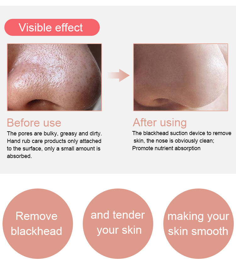 ORANGLES Facial Pore Vacuum Cleaner – Deep Acne & Blackhead Removal Tool - angled perspective - presenting advantages - Image 4 of 5 | fits any environment | Purchase Facial Pore Vacuum Cleaner – Deep Acne & Blackhead Removal Tool Michigan | Free Shipping ORANGLES